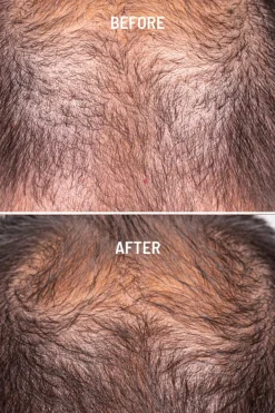 Hair Growth & Density tratamiento capilar